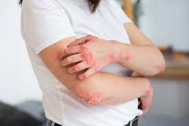 Combating Eczema
